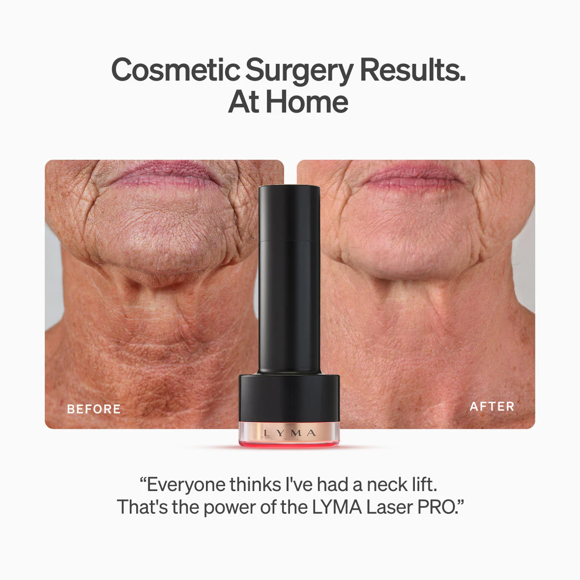Lyma - The LYMA Laser PRO - Image 3
